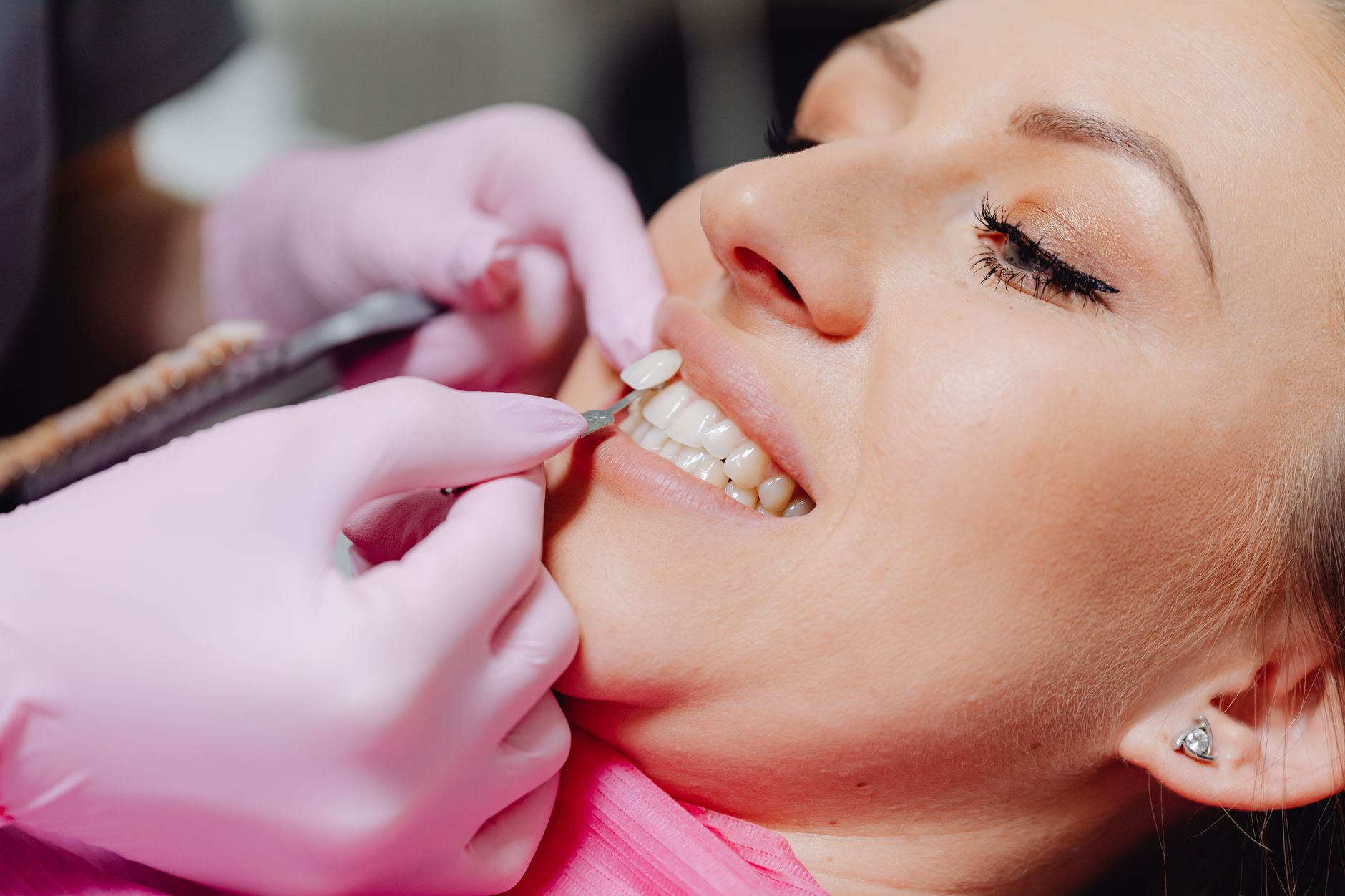 Pacientă cu zâmbet alb perfect după aplicarea fațetelor dentare
